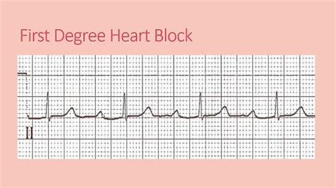 First degree heart block - YouTube