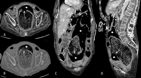 79 year old female with stercoral perforation of the rectum. Findings ...