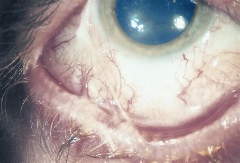 Inferior symblepharon as a result of ocular cicatricial pemphigoid ...