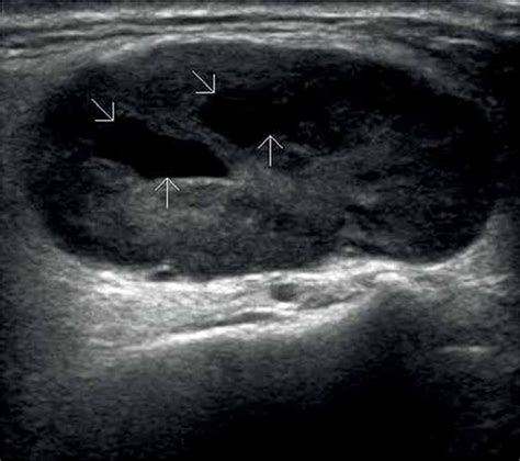 Pin on parotid - submandibular salivary