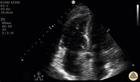 Echocardiography — TPA