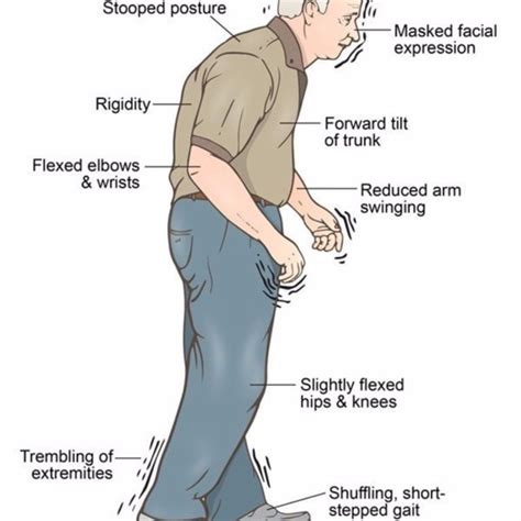 Parkinson's Disease - Legacy Spine & Neurological Specialists