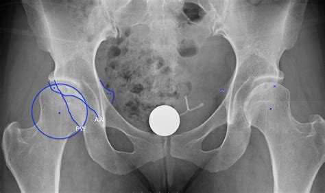 Acetabular Retroversion - Orthopedic Clinics