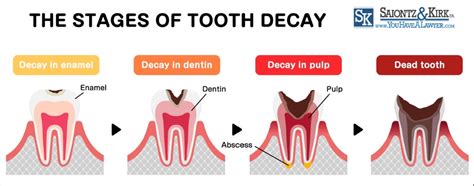 Suboxone Dental Side Effects - Saiontz & Kirk, P.A. - YouHaveALawyer.com