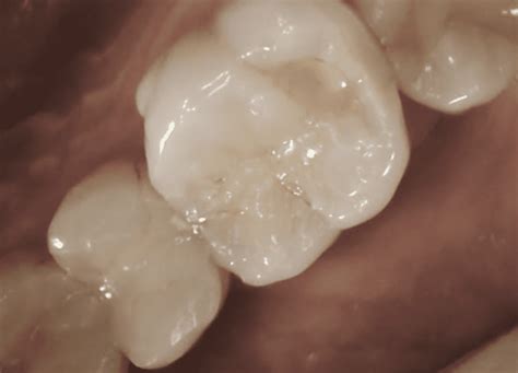 Cavity Fillings - Dentistry