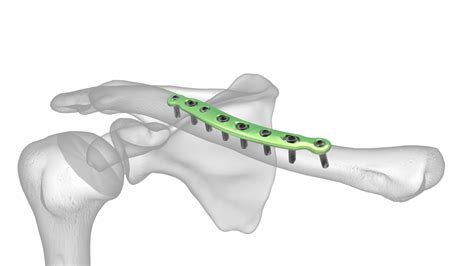 Midshaft Clavicle Plate | Acumed