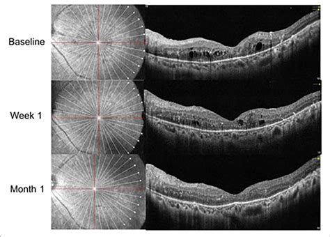 | OCT follow-up visit of the same patient with Ozurdex treatment. | Download Scientific Diagram