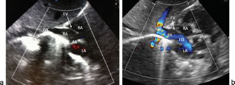 (a) Subcostal echocardiogram view with color Doppler depicting ...