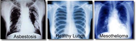 Asbestosis is a lung condition caused by inhaling high levels of ...