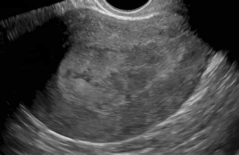 Endometrial cancer. Sagittal ultrasound image of the uterus shows a ...