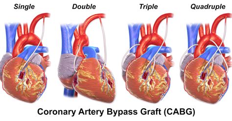 Heart bypass surgery, or coronary artery bypass surgery, is used to replace damaged arteries ...