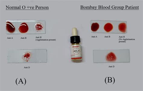 View Blood Type A Agglutination Background | Blood Type