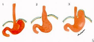 Hialtal Hernia：实践必需品，背景，病理生理学