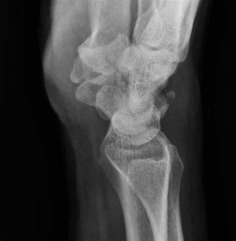 Triquetral fracture | Radiology Case | Radiopaedia.org | Radiology ...