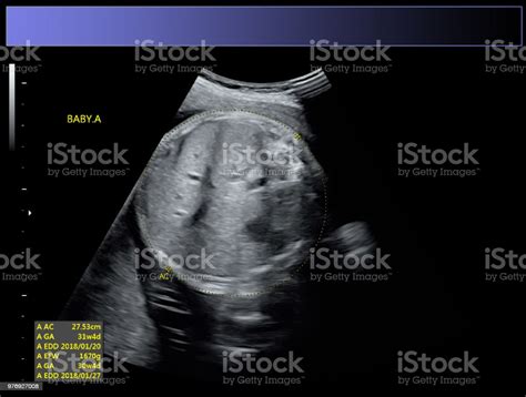 Identical Twin Boys Obstetrical Ultrasound Stock Photo - Download Image Now - Abdomen, Adult ...