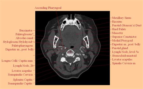 Ascending Pharyngeal Artery | neuroangio.org