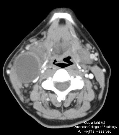 Neuroradiology On the Net: Branchial cleft cyst