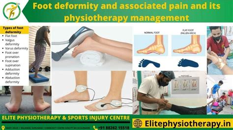 Foot Deformity and Associated Pain and Its Physiotherapy Management