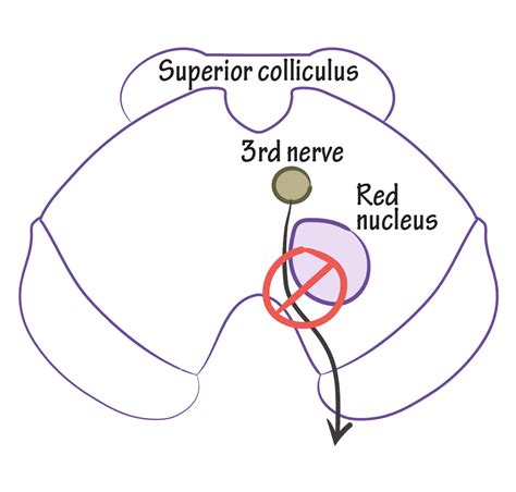 Neuroanatomy Glossary: Midbrain Stroke: Benedikt's Syndrome | Draw It to Know It