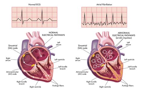 Difference between Atrial Fibrillation and Atrial Flutter | Pulse ...