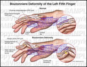 Boutonniere Deformity of the Left Fifth Finger - Medivisuals Inc.