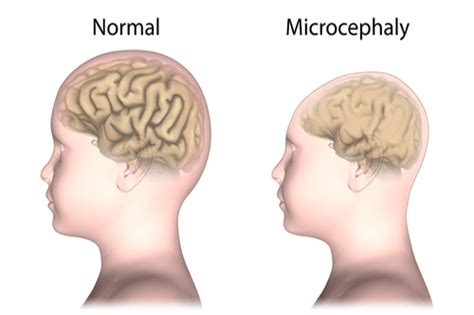 Microcephaly : Causes, transmission, symptoms, & prevention | FactDr