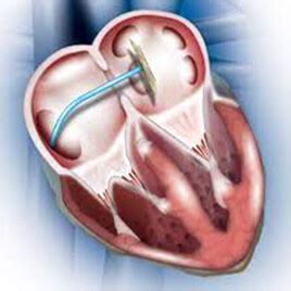 Non Surgical Alternatives in treatment of Congenital Heart Defects - Blog