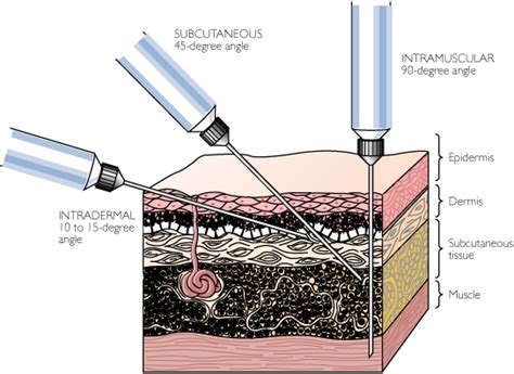 Intramuscular Injections