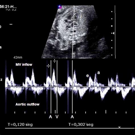 Main Characteristics of the Different Types of Fetal Tachycardia ...