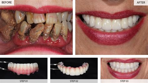 Tooth Implant Before After