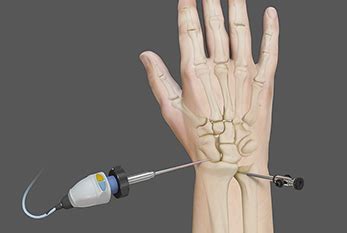 Wrist Arthroscopy Centreville, VA | Wrist Arthritis Treatment Ashburn ...