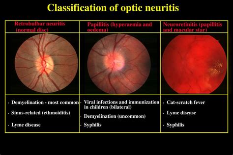 Optic Neuritis Mri