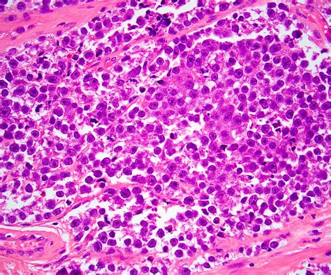 Pathology Outlines - Seminoma