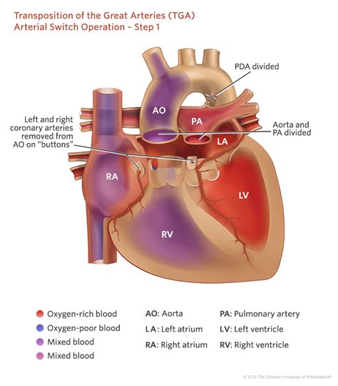 Transposition of the Great Arteries | Children's Hospital of Philadelphia