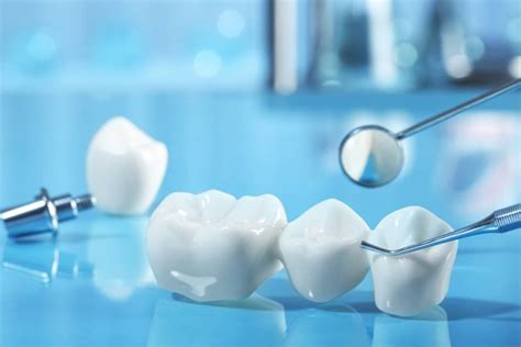 Best Materials for Dental Bridges | Smiles Of La Mesa - Blog