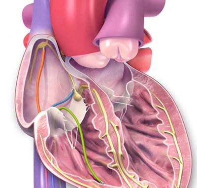 catheter ablation