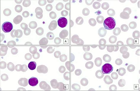 Alder-Reilly Anomaly: Morphologic Clue in a Patient with Hunter Syndrome