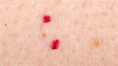 Cherry Angiomas: How to Get Rid of Those Bright Red ‘Moles’ | Best Health