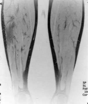 MRI of patient 1 (frontal section). Volume rise of the peroneal ...