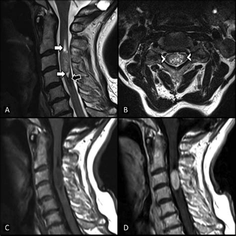 MRI features of intradural tumours | Download Table