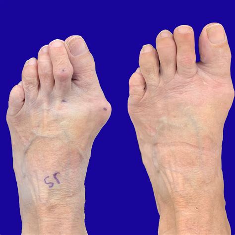 Before and After Bunion Surgery Photos | The Bunion Cure