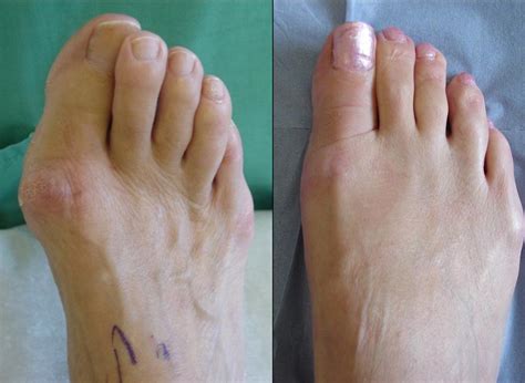 Foot Surgery - Clinica SANDALF Benalmadena, Costa del Sol