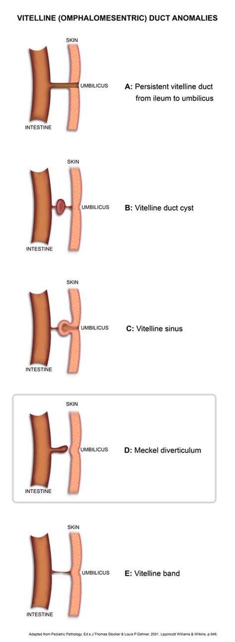 Meckel diverticulum | Pathology Learning Centre