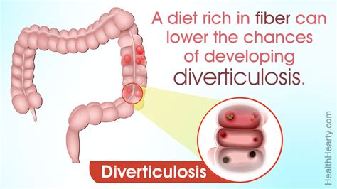 Diverticulosis is a problem that usually occurs if there is not enough intake of fiber in the ...