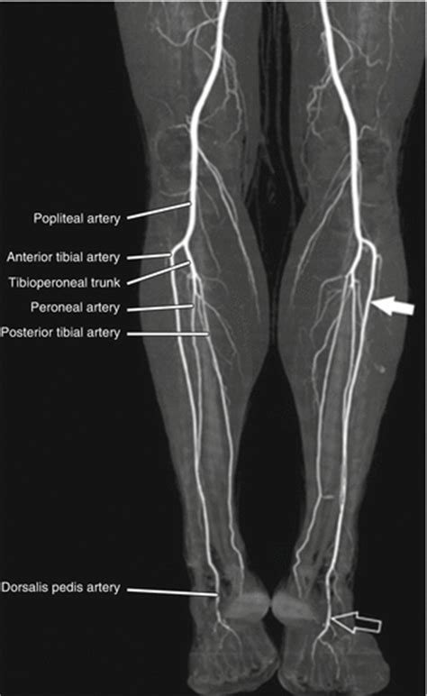 Below-Knee Popliteal, Tibial, and Foot Injuries | Thoracic Key