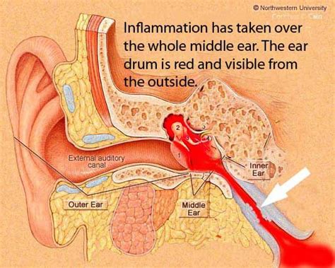 otitis media- what is going on in your head | Ear Infections | Ear infection, Cleaning your ears ...