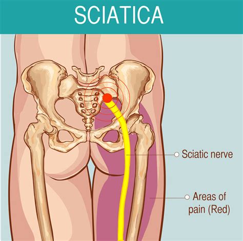 Acupuncture for Sciatica — Morningside Acupuncture NYC