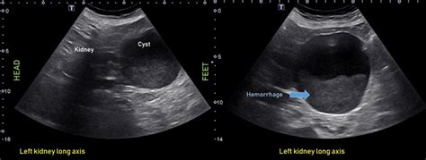 Kidney Ultrasound Cyst