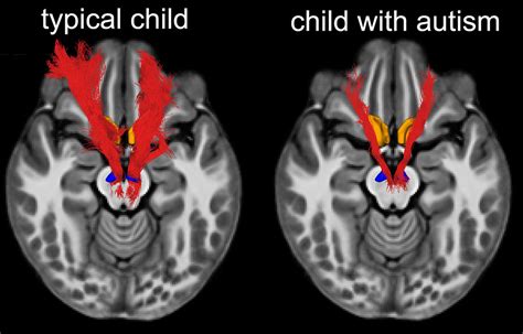 Key social reward circuit in the brain impaired in kids with autism ...