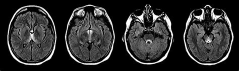 Wernicke Encephalopathy: MRI in a sixteen weeks pregnant woman with ...